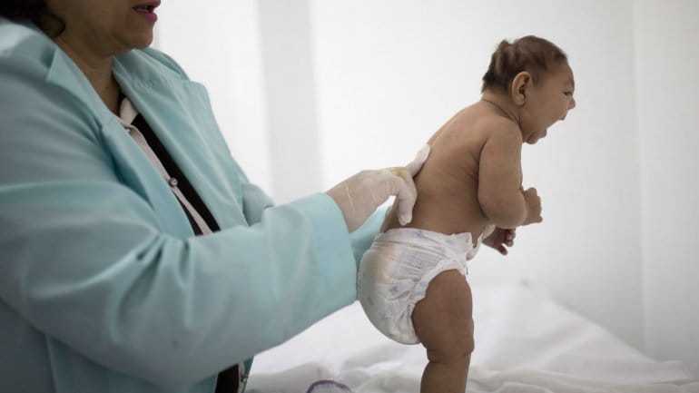 Terapia alternativa alivia síntomas de bebés con trastornos ligados al zika