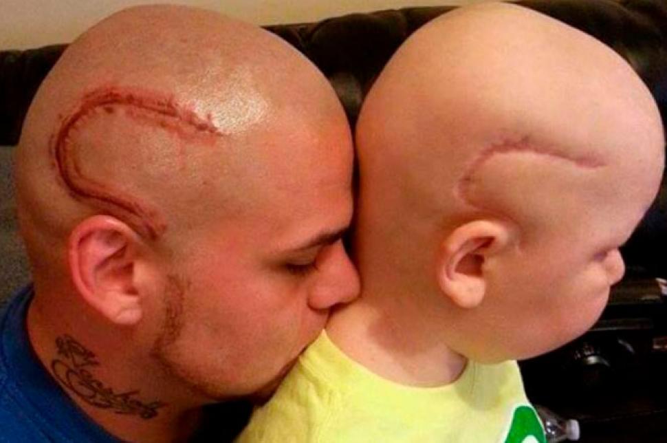 Falleció el niño cuyo padre se tatuó la misma cicatriz en su cabeza para darle ánimos