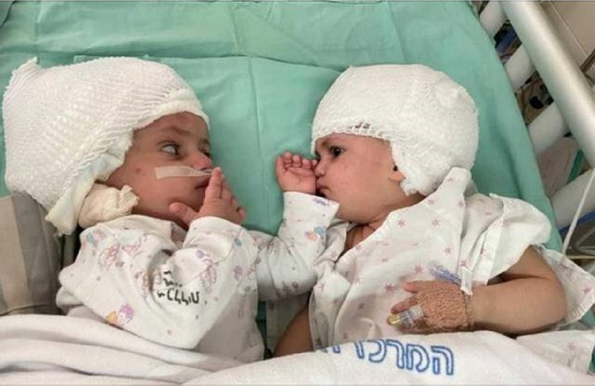 Médicos logran separar a gemelas unidas por la cabeza tras 12 horas de cirugía. Foto cortesía de American Friends of Soroka Medical Center